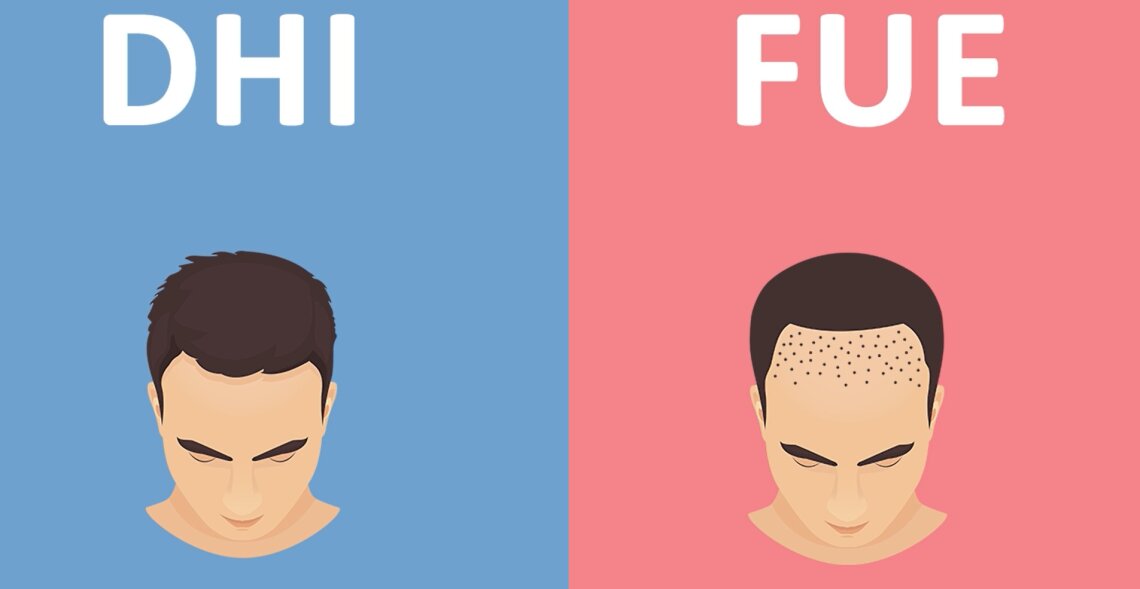 Методы пересадки волос DHI и FUE. Чем они отличаются?